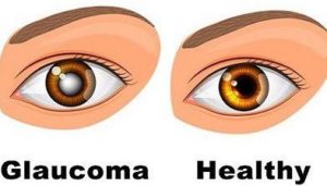 eye glaucoma